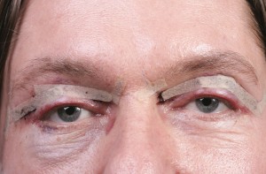 Man after the eyelid surgery